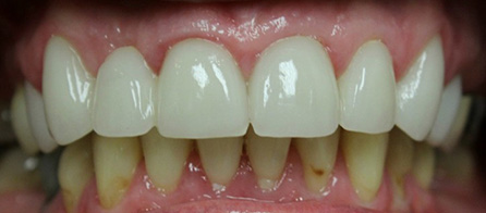 Bridge and Crowns (After)