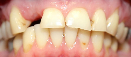 Bridge and Crowns (Before)