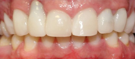 Crowns and Implants (After)