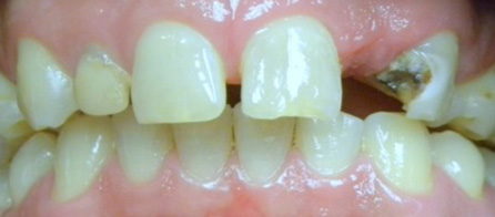 Crowns and Implants (Before)