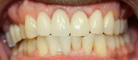 Crowns and Invisalign (After)