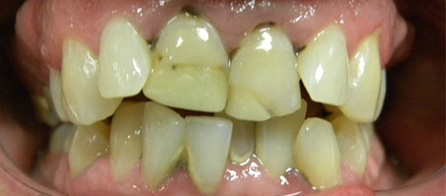 Crowns and Invisalign (Before)