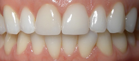 Crowns and Zoom Whitening (After)