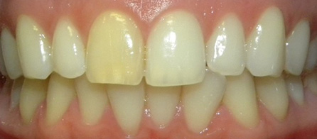Crowns and Zoom Whitening (Before)