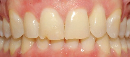 Invisalign 2 (After)