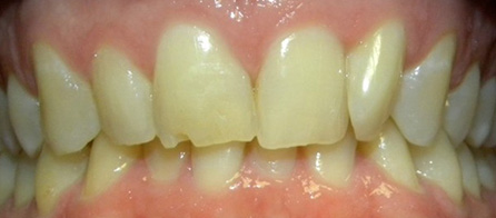 Invisalign 2 (Before)