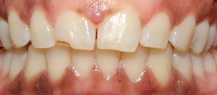 Invisalign 3 (After)