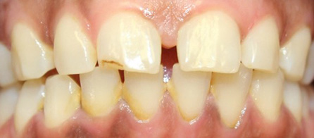 Invisalign 3 (Before)