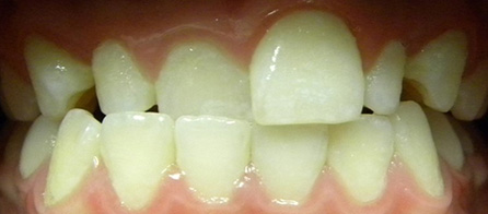 Invisalign (Before)